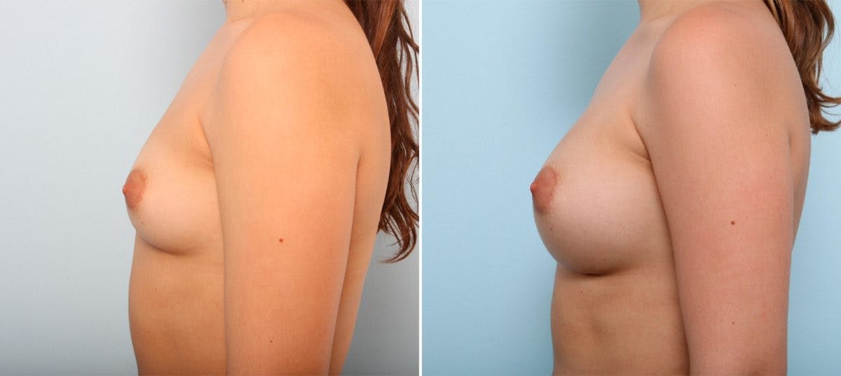 Breast Augmentation Before & After Gallery - Patient 54887266 - Image 5