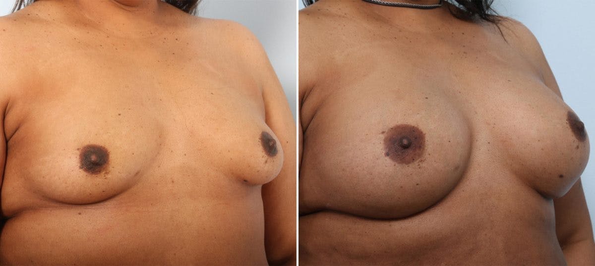 Breast Augmentation Before & After Gallery - Patient 54887267 - Image 2