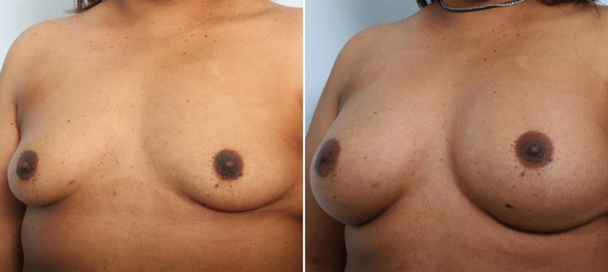 Breast Augmentation Before & After Gallery - Patient 54887267 - Image 4