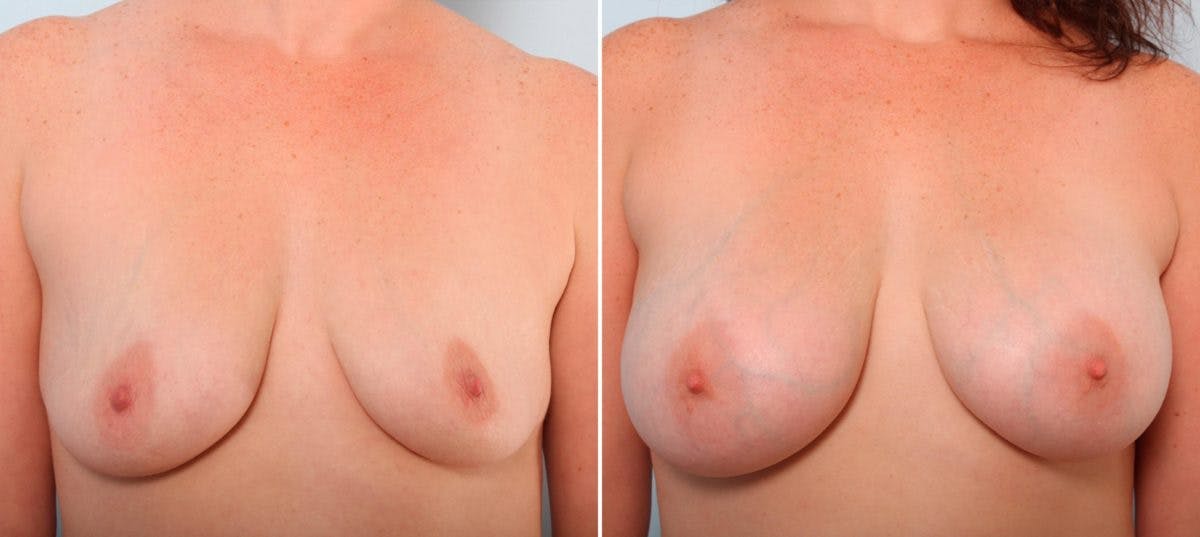 Breast Augmentation Before & After Gallery - Patient 54887270 - Image 1