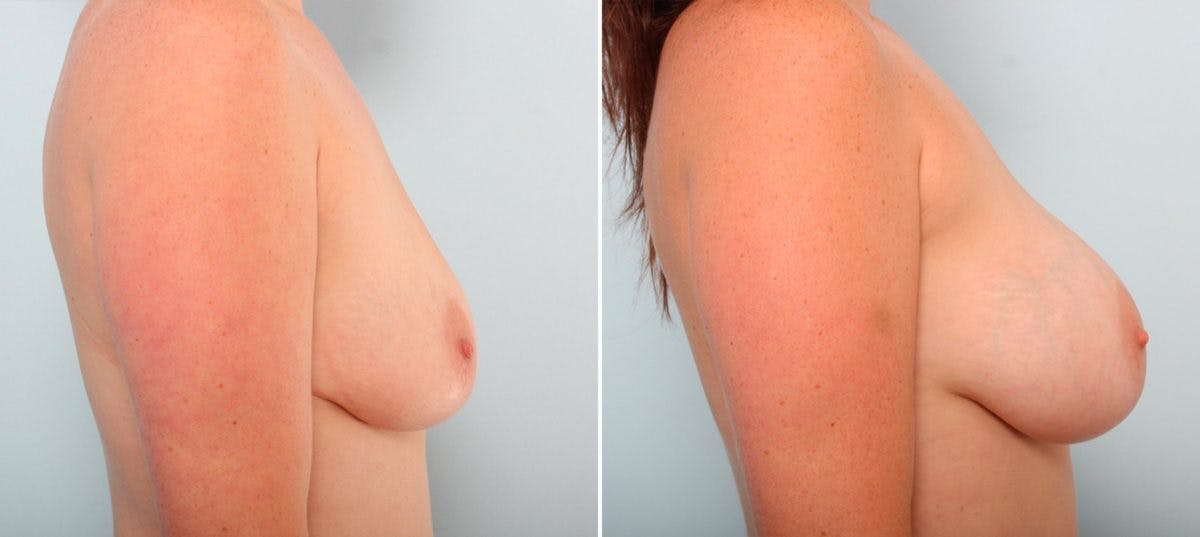 Breast Augmentation Before & After Gallery - Patient 54887270 - Image 3