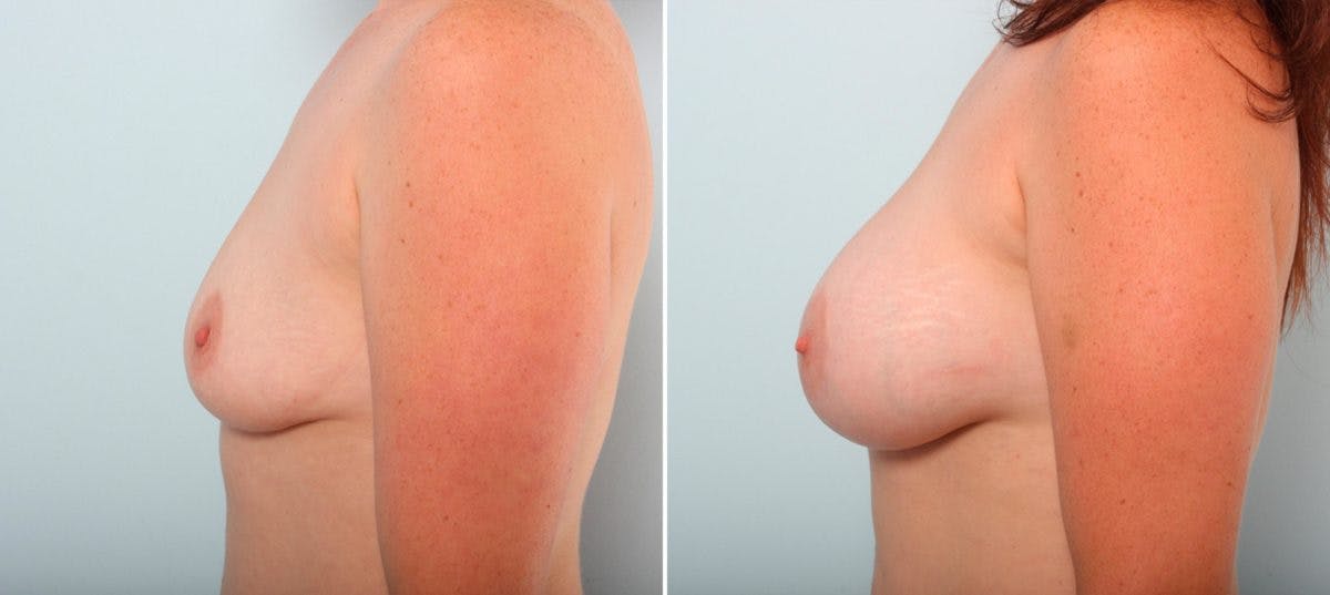 Breast Augmentation Before & After Gallery - Patient 54887270 - Image 5