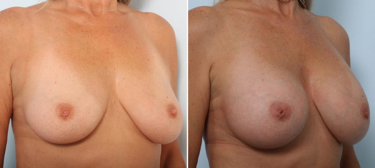 Breast Augmentation Before & After Gallery - Patient 54887271 - Image 2