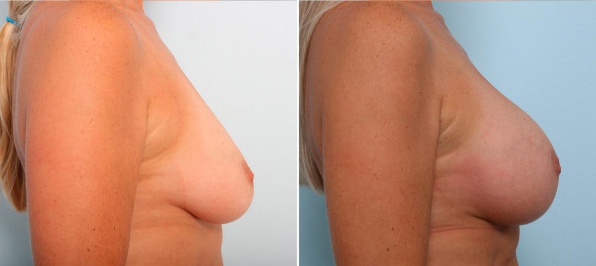 Breast Augmentation Before & After Gallery - Patient 54887271 - Image 3