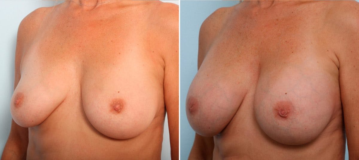Breast Augmentation Before & After Photo - Patient 54887271 - Image 4