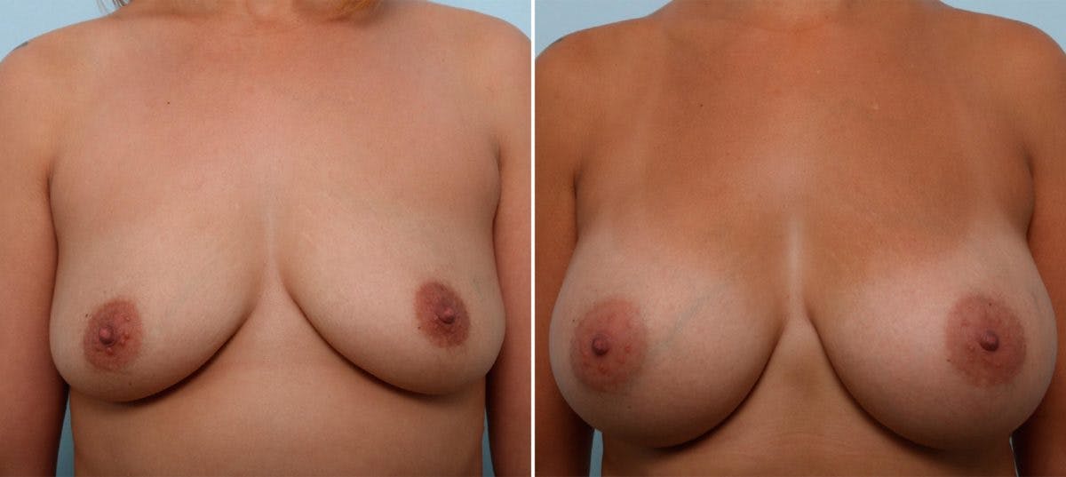 Breast Augmentation Before & After Gallery - Patient 54887274 - Image 1