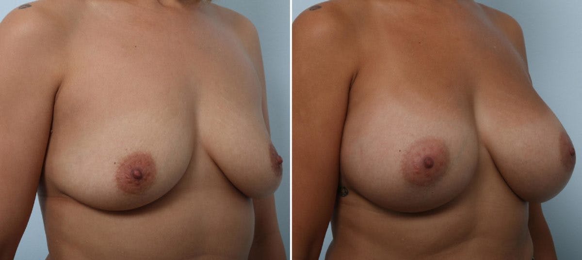 Breast Augmentation Before & After Gallery - Patient 54887274 - Image 2