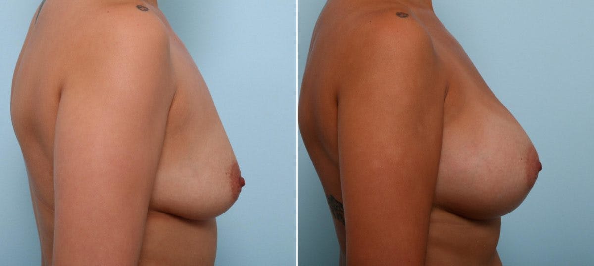 Breast Augmentation Before & After Gallery - Patient 54887274 - Image 3