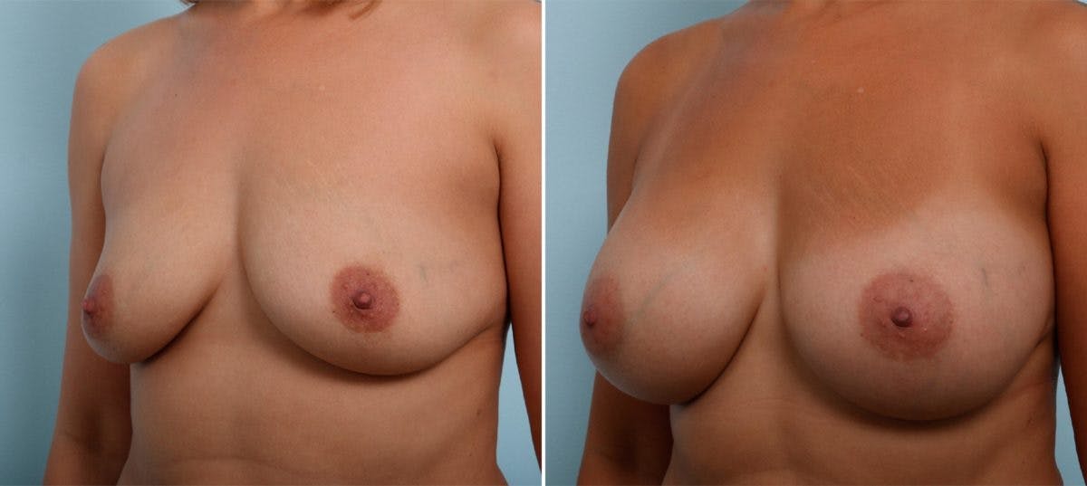 Breast Augmentation Before & After Gallery - Patient 54887274 - Image 4
