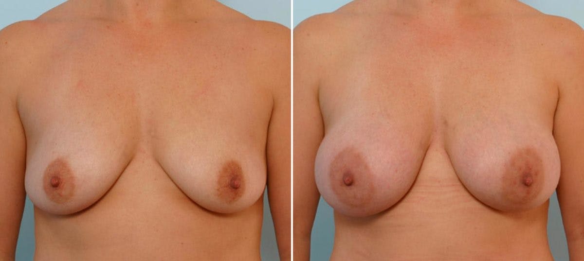 Breast Augmentation Before & After Gallery - Patient 54887276 - Image 1