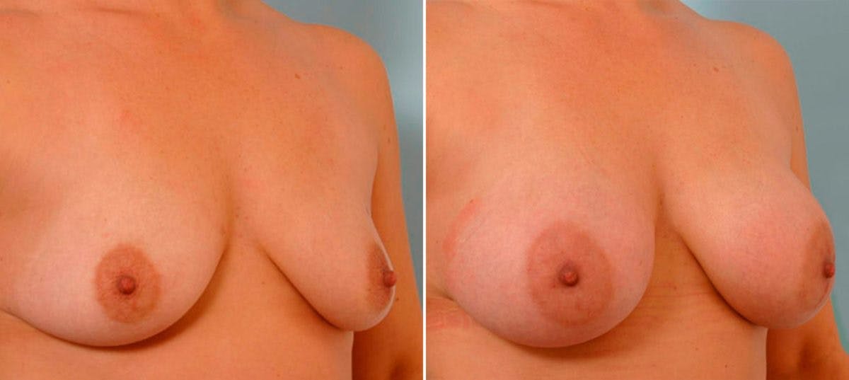 Breast Augmentation Before & After Gallery - Patient 54887276 - Image 2