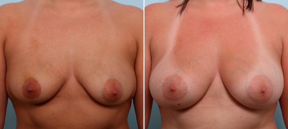 Breast Augmentation Before & After Gallery - Patient 54887332 - Image 1