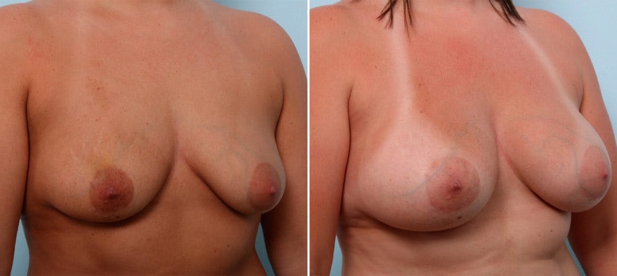 Breast Augmentation Before & After Gallery - Patient 54887332 - Image 2
