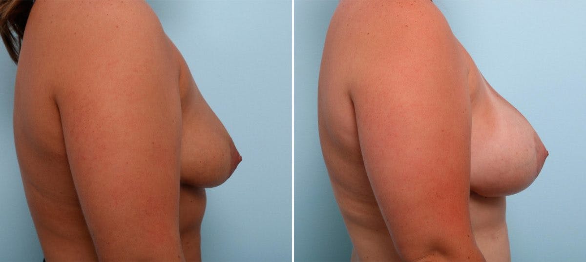 Breast Augmentation Before & After Gallery - Patient 54887332 - Image 3