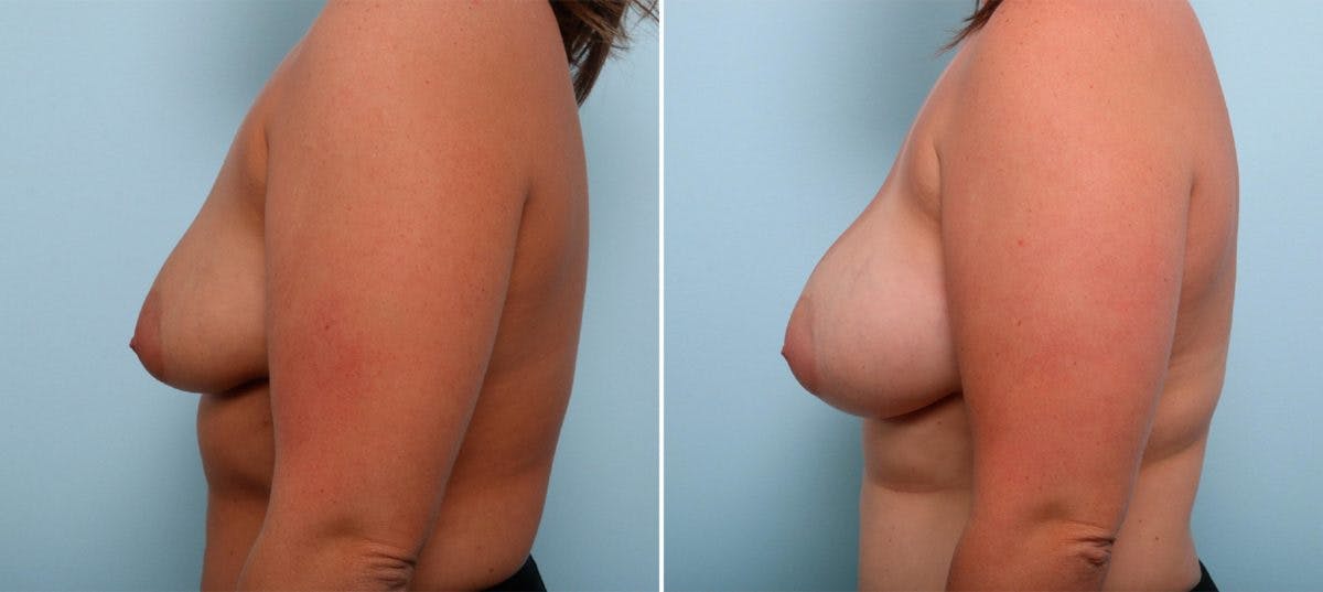 Breast Augmentation Before & After Gallery - Patient 54887332 - Image 5