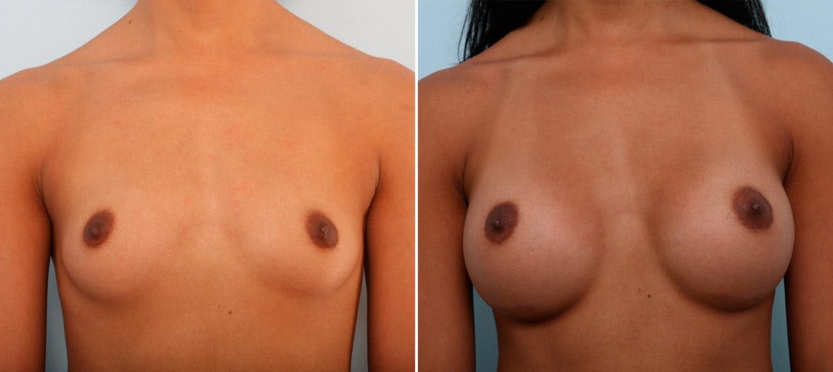 Breast Augmentation Before & After Gallery - Patient 54887333 - Image 1