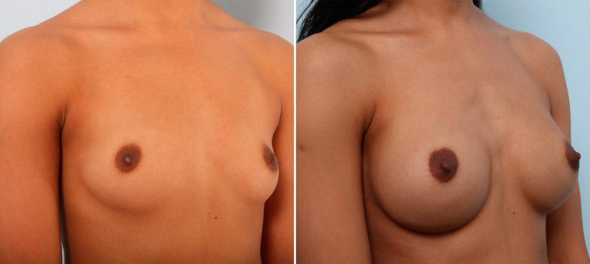 Breast Augmentation Before & After Gallery - Patient 54887333 - Image 2