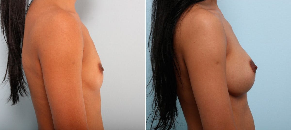 Breast Augmentation Before & After Gallery - Patient 54887333 - Image 3