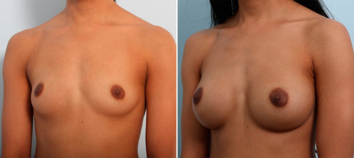 Breast Augmentation Before & After Gallery - Patient 54887333 - Image 4