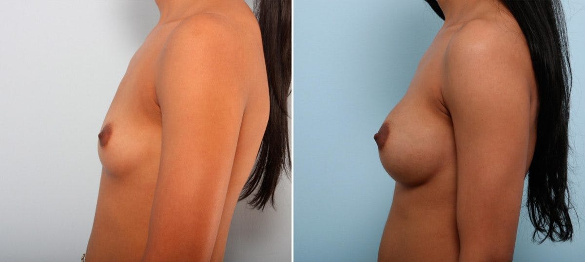 Breast Augmentation Before & After Gallery - Patient 54887333 - Image 5