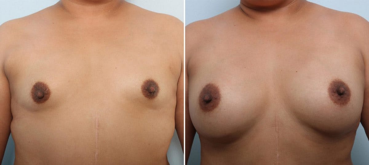 Breast Augmentation Before & After Gallery - Patient 54887335 - Image 1