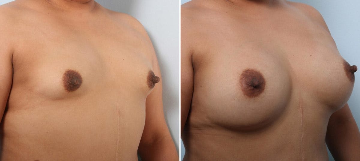 Breast Augmentation Before & After Gallery - Patient 54887335 - Image 2