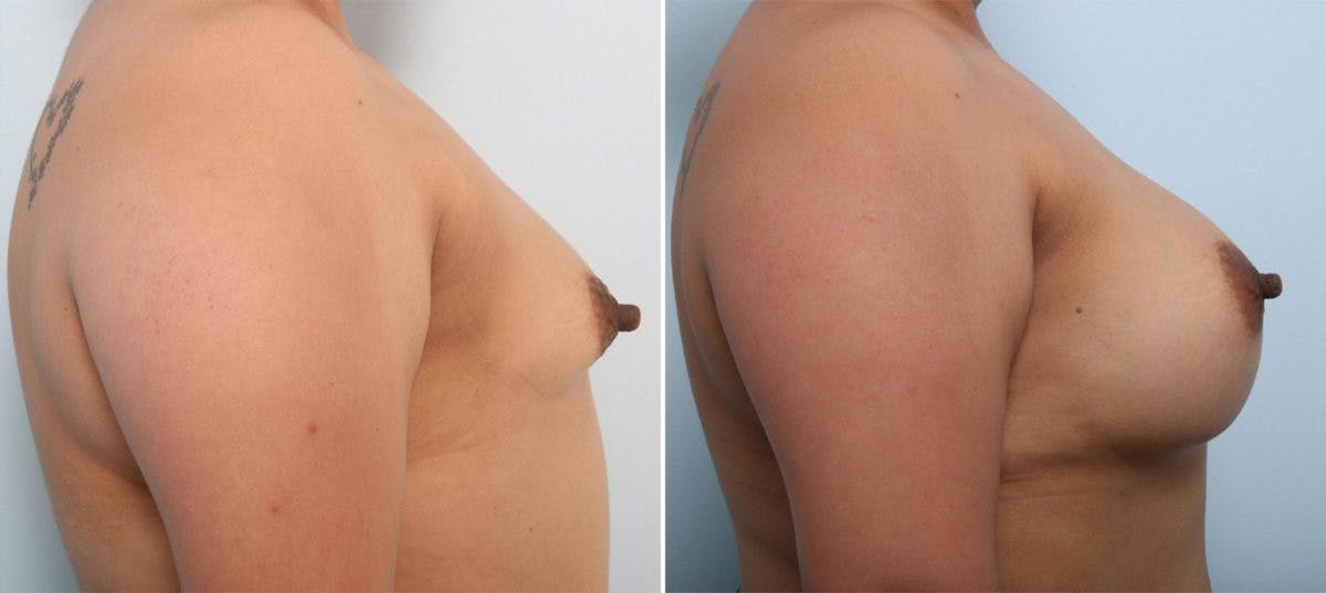 Breast Augmentation Before & After Gallery - Patient 54887335 - Image 3