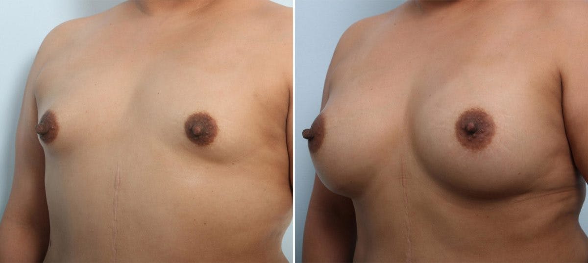Breast Augmentation Before & After Gallery - Patient 54887335 - Image 4