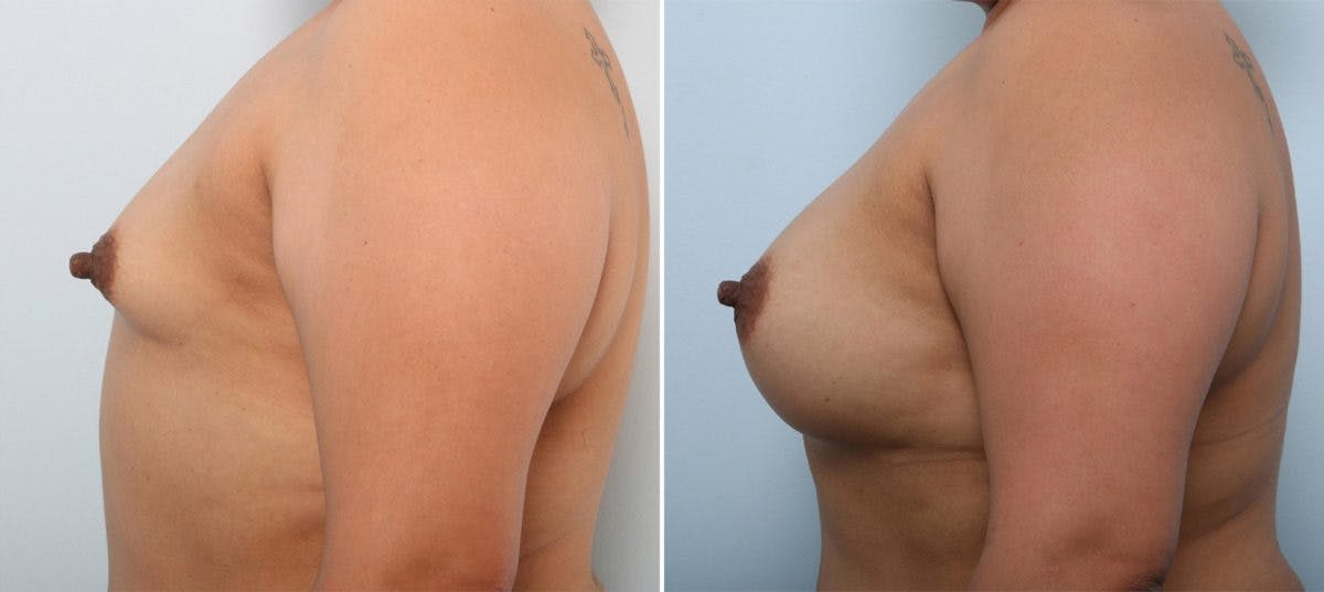 Breast Augmentation Before & After Gallery - Patient 54887335 - Image 5