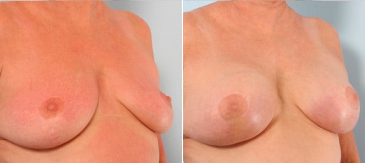Breast Augmentation Before & After Gallery - Patient 54887337 - Image 2