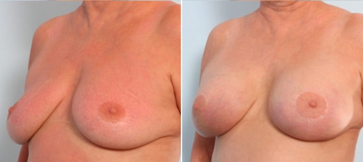 Breast Augmentation Before & After Gallery - Patient 54887337 - Image 4