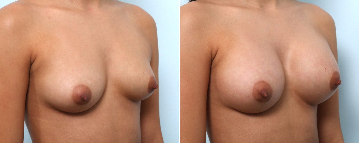 Breast Augmentation Before & After Gallery - Patient 54887338 - Image 2