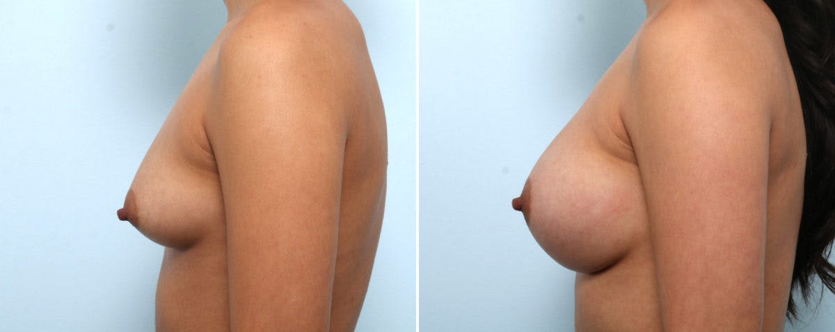 Breast Augmentation Before & After Gallery - Patient 54887338 - Image 3