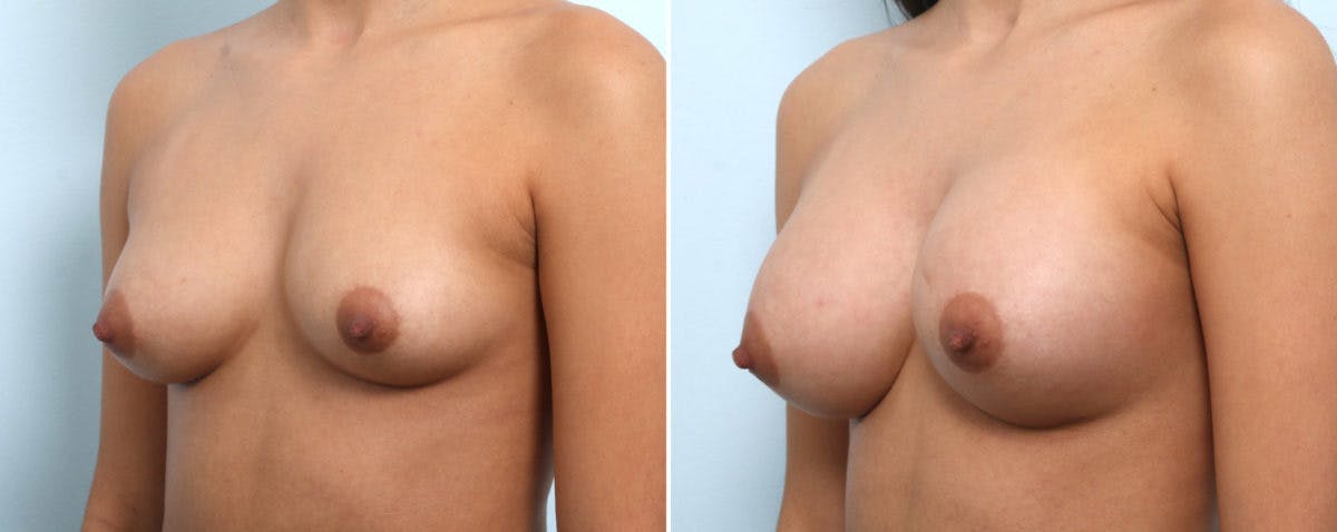 Breast Augmentation Before & After Gallery - Patient 54887338 - Image 4