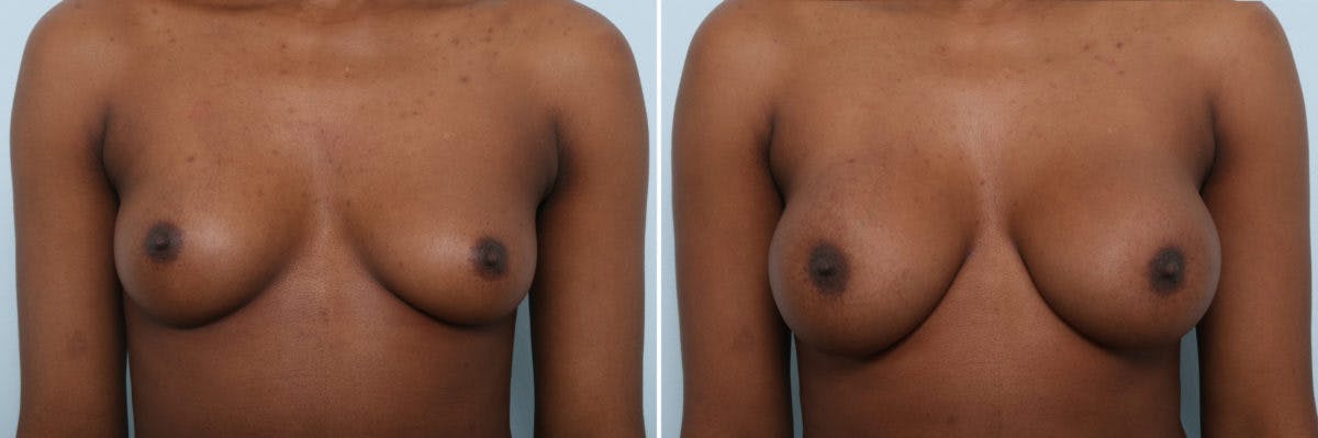 Breast Augmentation Before & After Gallery - Patient 54887340 - Image 1