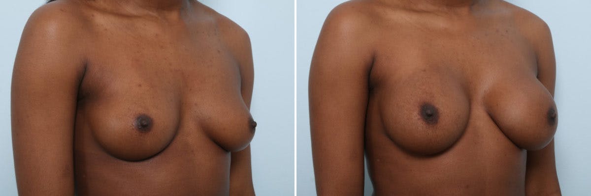Breast Augmentation Before & After Gallery - Patient 54887340 - Image 2