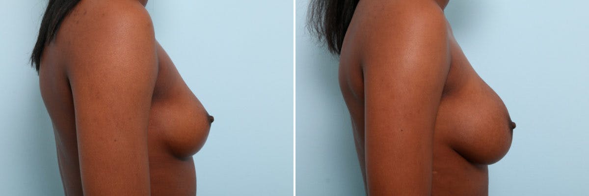 Breast Augmentation Before & After Gallery - Patient 54887340 - Image 3