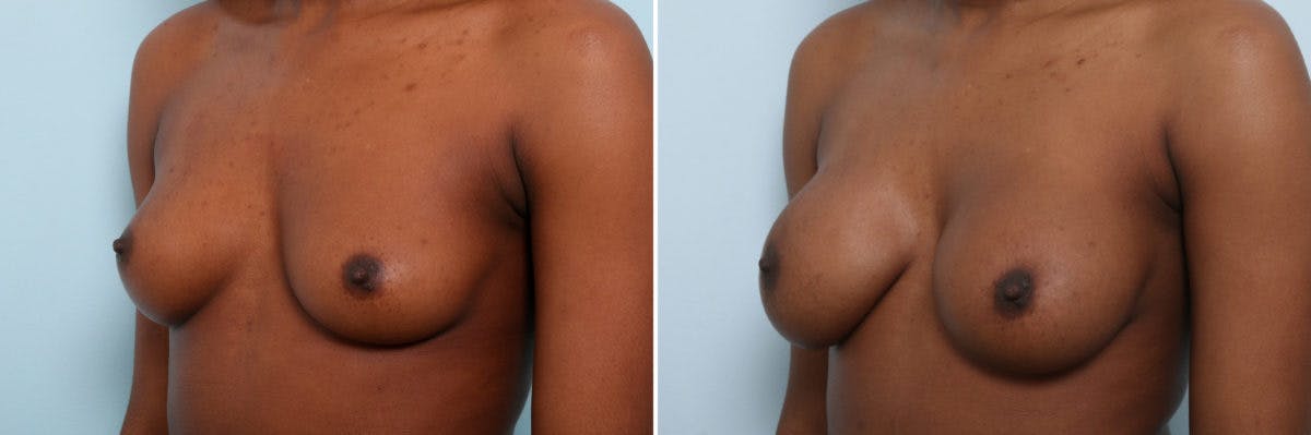 Breast Augmentation Before & After Gallery - Patient 54887340 - Image 4