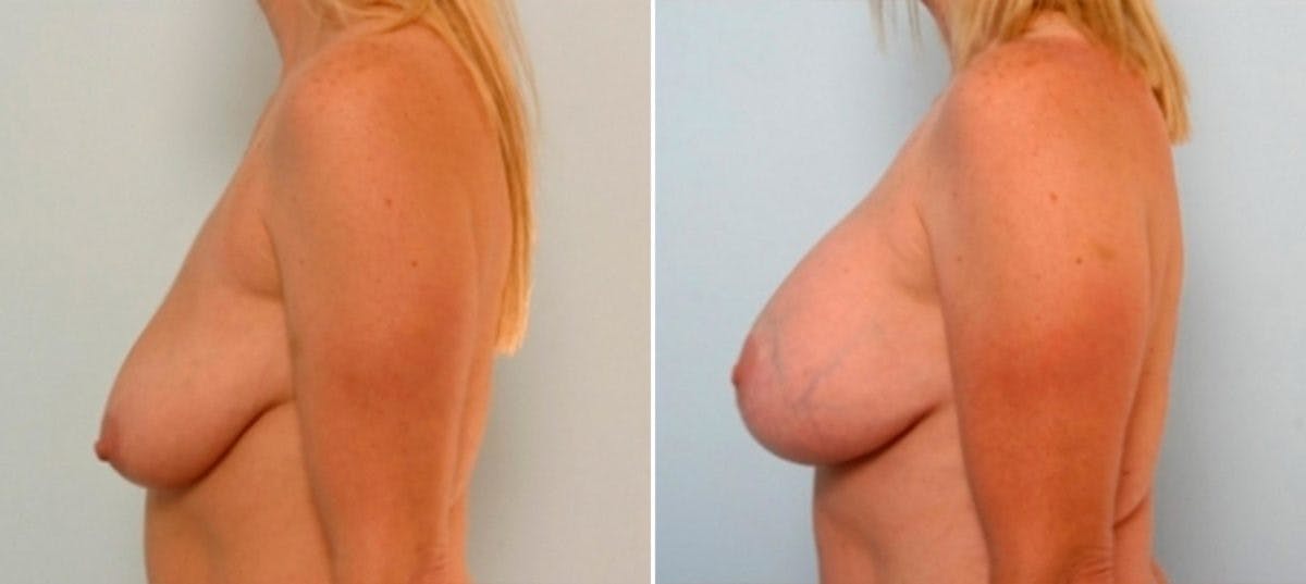 Breast Augmentation-Mastopexy Before & After Gallery - Patient 55021437 - Image 3