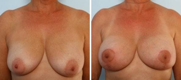 Breast Augmentation-Mastopexy Before & After Gallery - Patient 55021438 - Image 1