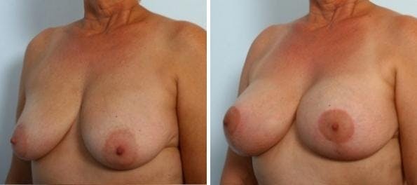 Breast Augmentation-Mastopexy Before & After Gallery - Patient 55021438 - Image 2