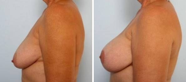 Breast Augmentation-Mastopexy Before & After Gallery - Patient 55021438 - Image 3