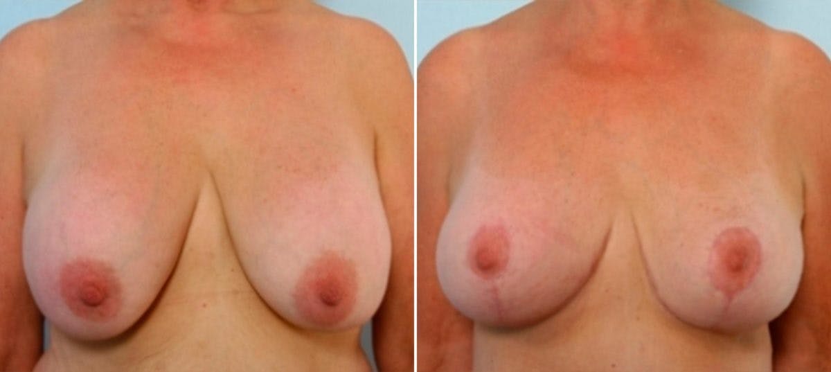 Breast Augmentation-Mastopexy Before & After Gallery - Patient 55021440 - Image 1