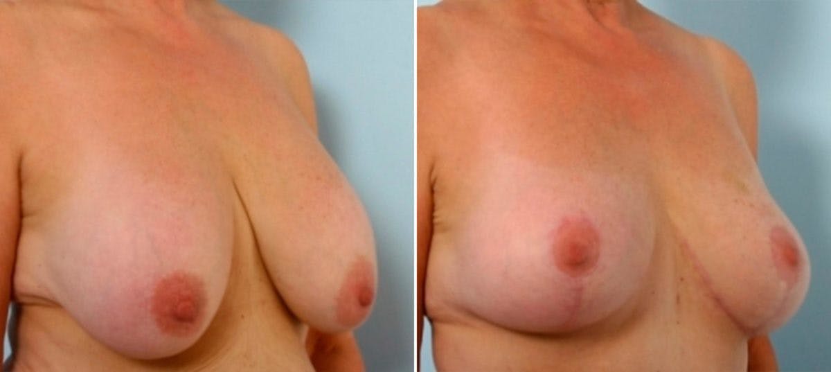 Breast Augmentation-Mastopexy Before & After Gallery - Patient 55021440 - Image 2