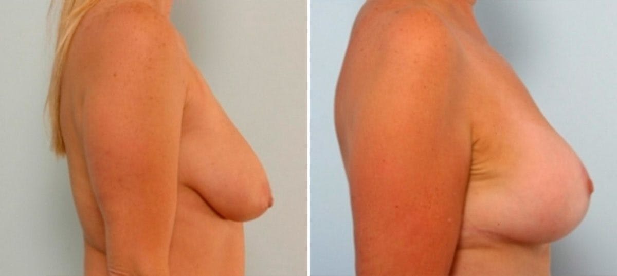 Breast Augmentation-Mastopexy Before & After Gallery - Patient 55021440 - Image 3