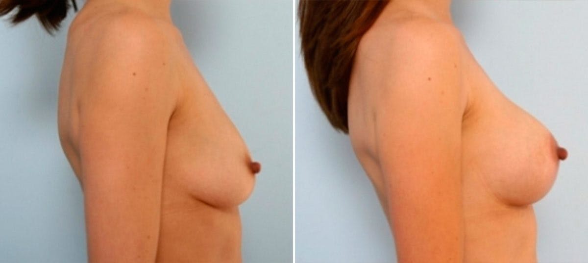 Breast Augmentation-Mastopexy Before & After Gallery - Patient 55021442 - Image 3