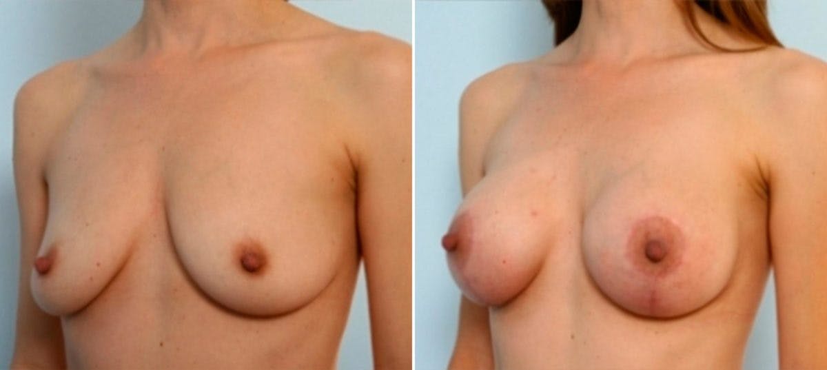 Breast Augmentation-Mastopexy Before & After Gallery - Patient 55021442 - Image 4