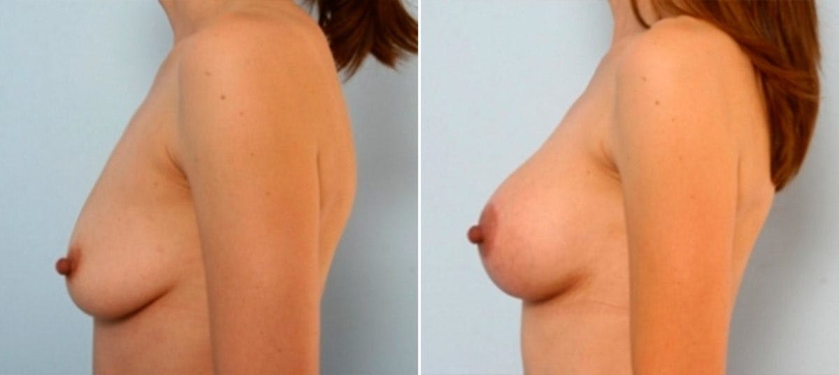 Breast Augmentation-Mastopexy Before & After Gallery - Patient 55021442 - Image 5