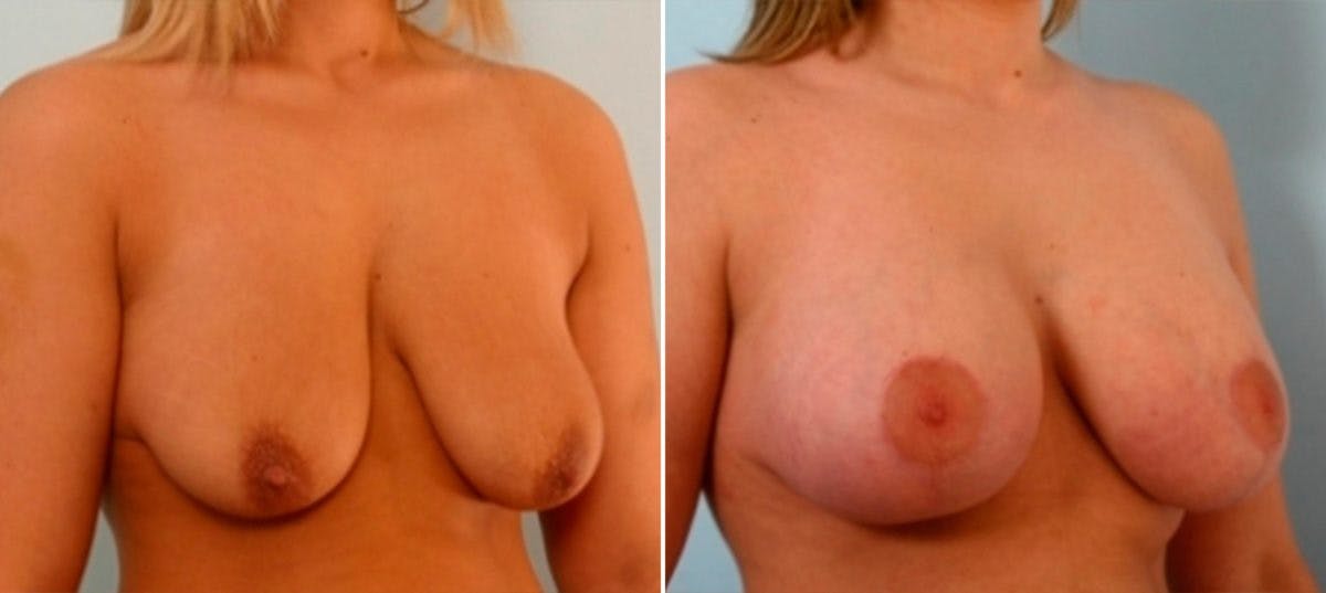 Breast Augmentation-Mastopexy Before & After Gallery - Patient 55021448 - Image 2
