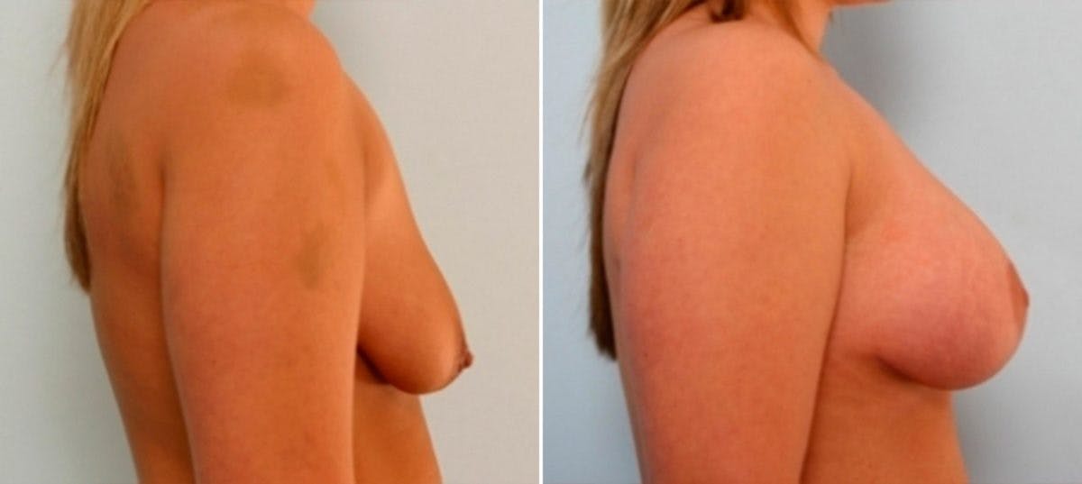 Breast Augmentation-Mastopexy Before & After Gallery - Patient 55021448 - Image 3